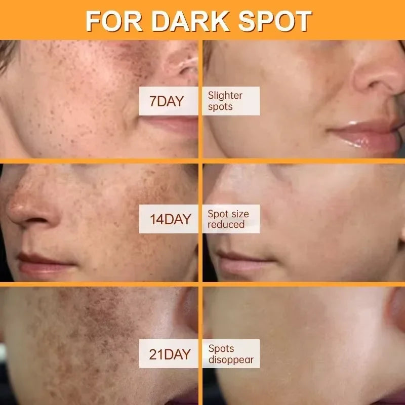 Whitening Freckles Face Cream Removal Melasma Dark Spots Corrector Lighten Melanin Pigmentation Brighten Anti-Aging Beauty Care by PETAL & GLOW