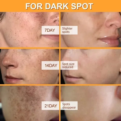 Whitening Freckles Face Cream Removal Melasma Dark Spots Corrector Lighten Melanin Pigmentation Brighten Anti-Aging Beauty Care by PETAL & GLOW