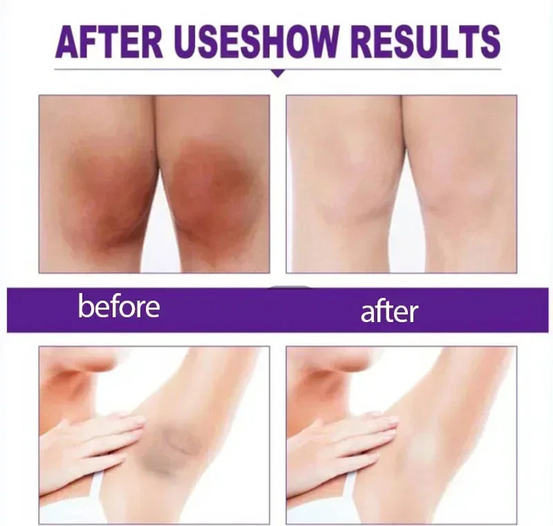 Whitening Cream Private Parts Underarm Bleaching Whiten Butt Knee Brighten Inner Thigh Intimate Parts Dark Remove Melanin by PETAL & GLOW